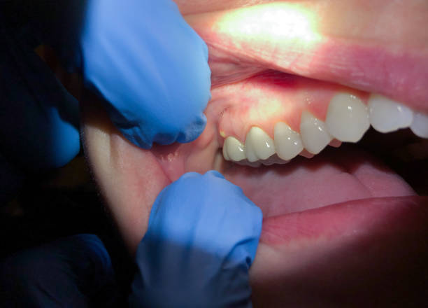 Best Dental Abscess Treatment in Elwood, KS